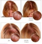 Средство Ultra hair system лучшая альтернатива пересадке волос и парикам 57998543