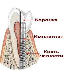 зубной имплант