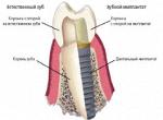 Зубные импланты