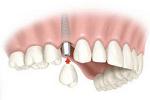 Имплантанты зубные